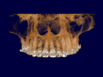 Insights Diagnostic CBCT Scan Services 11 x 5 cm (Maxilla or Mandible)
